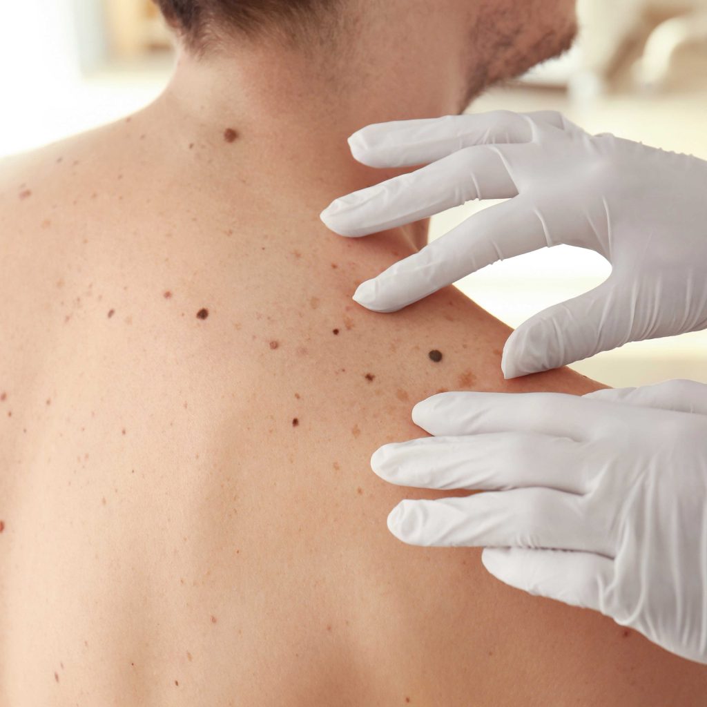 Mole Removal Unique Dermatology And Spa